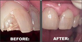 Dental Crowns before and after